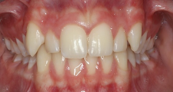 Before Teeth